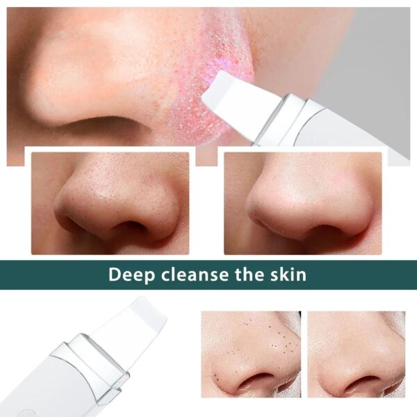 Ultrasonic Deep-Clean Skin Scrubber & Blackhead Remover - Image 3